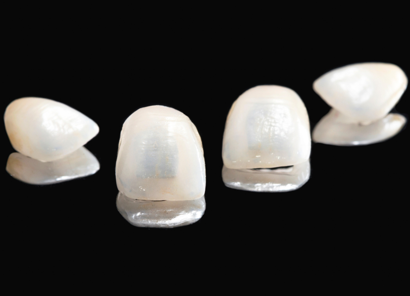 ポーセレンラミネートベニア|板橋グレース歯科医院