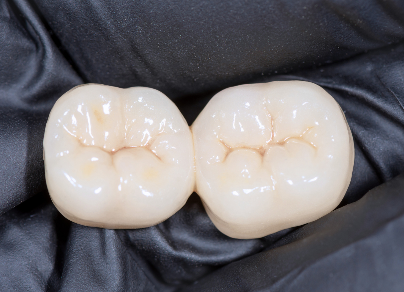 ジルコニアクラウン|板橋グレース歯科医院