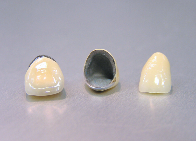 メタルボンド|板橋グレース歯科医院