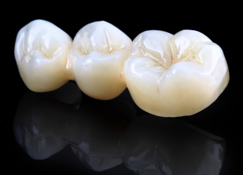 セラミックブリッジ|板橋グレース歯科医院