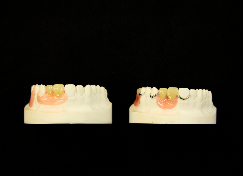 様々な種類の入れ歯がある理由｜板橋グレース歯科医院