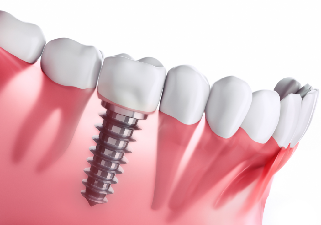 インプラント治療｜板橋グレース歯科医院