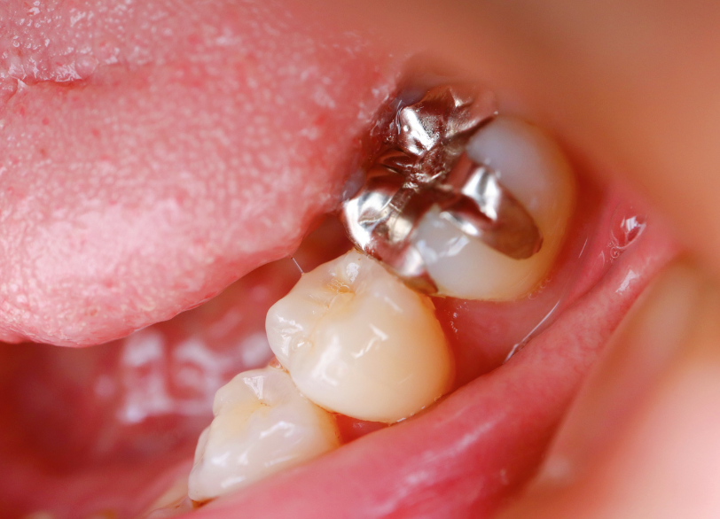 銀歯|板橋グレース歯科医院