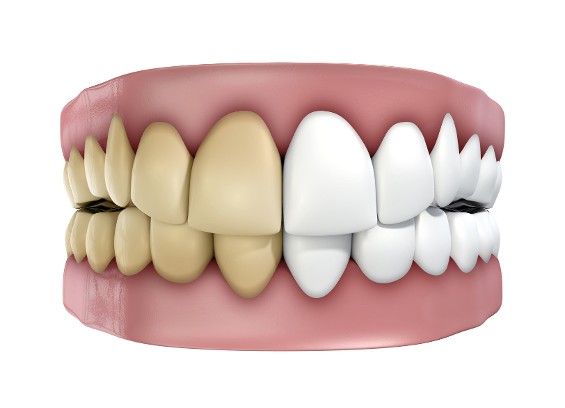 歯の色が変わる、様々な原因｜板橋グレース歯科医院