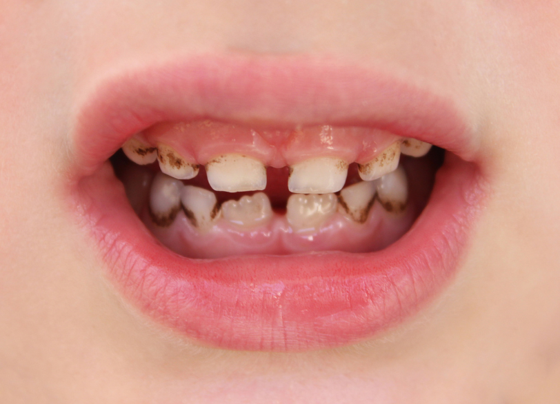 なぜ乳歯のむし歯を放置してはいけないのか｜板橋グレース歯科医院