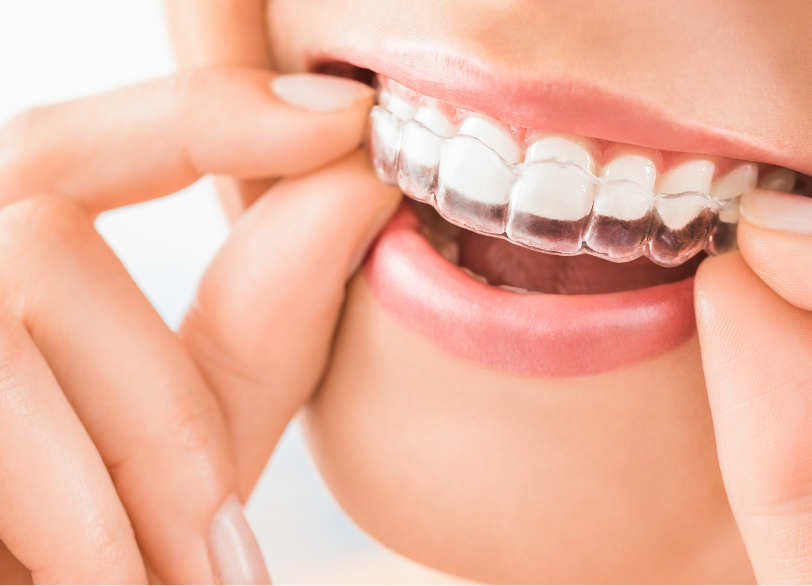 今成人矯正を選ぶ方が増えています｜板橋グレース歯科医院