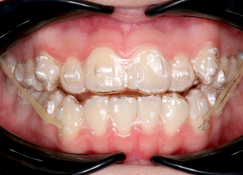 アタッチメント｜板橋グレース歯科医院