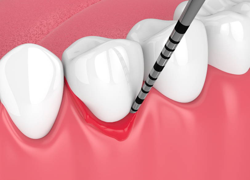 あなたの歯は大丈夫ですか？｜板橋グレース歯科医院
