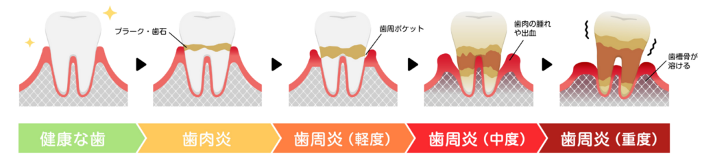歯周病の進行｜板橋グレース歯科医院