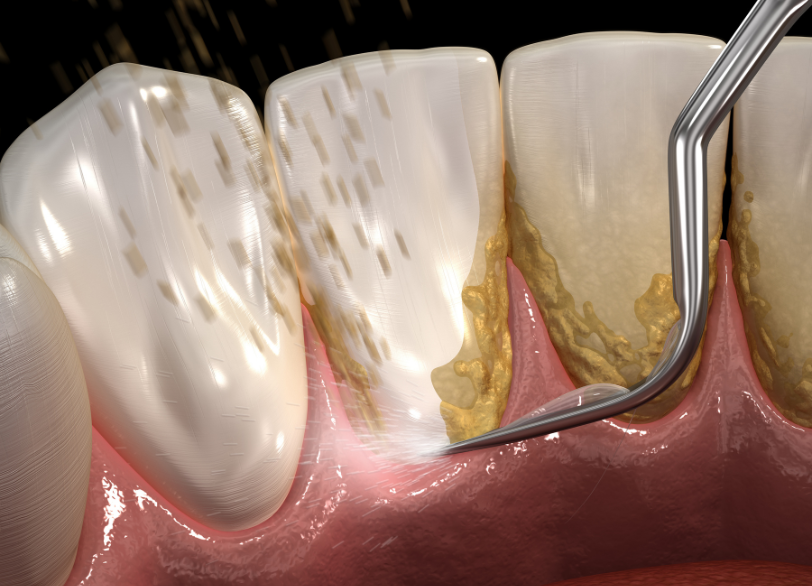 ルートプレーニング｜板橋グレース歯科医院