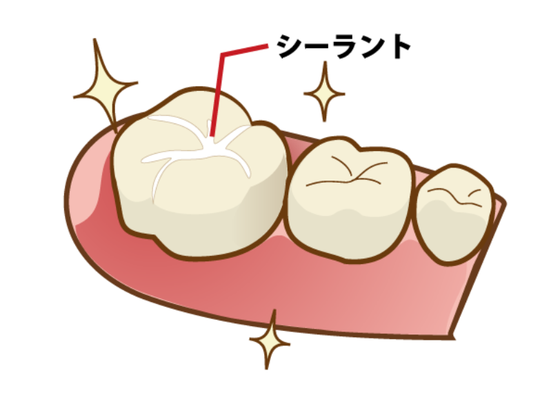 シーラント｜板橋グレース歯科医院