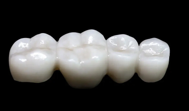 ブリッジ|板橋グレース歯科医院