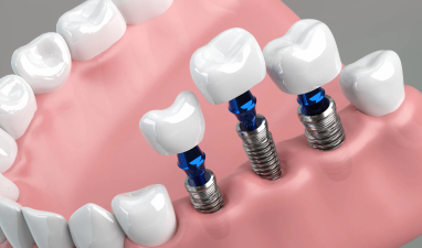 インプラント|板橋グレース歯科医院