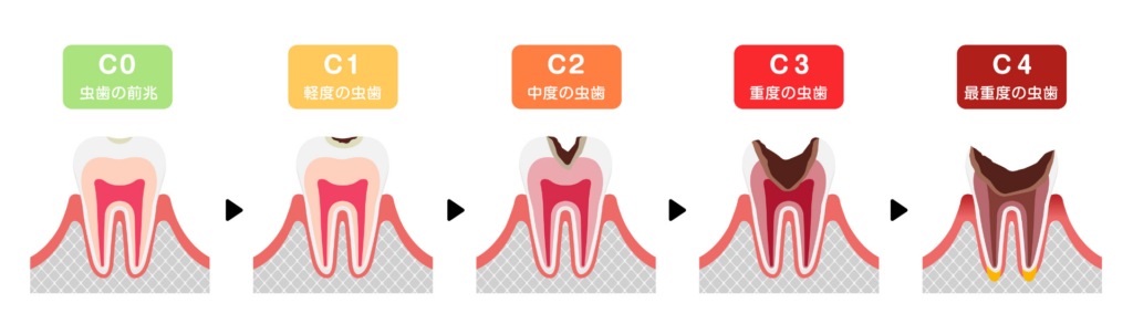 虫歯の進行｜板橋グレース歯科医院