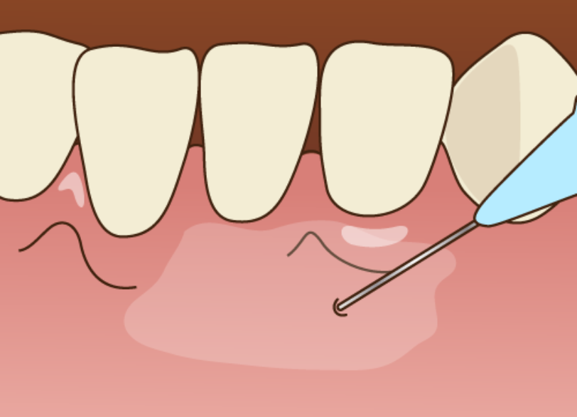 丁寧な麻酔処置｜板橋グレース歯科医院