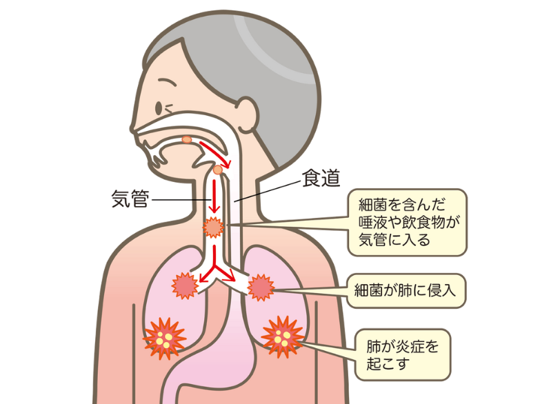 誤嚥性肺炎｜板橋グレース歯科医院