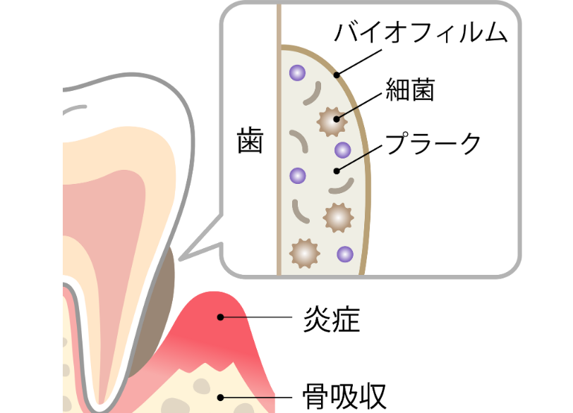 細菌の塊｜板橋グレース歯科医院