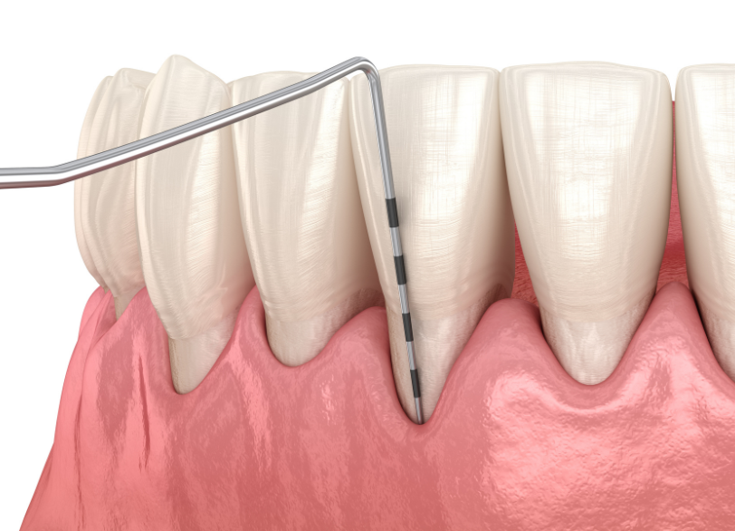 歯周ポケット検査｜板橋グレース歯科医院