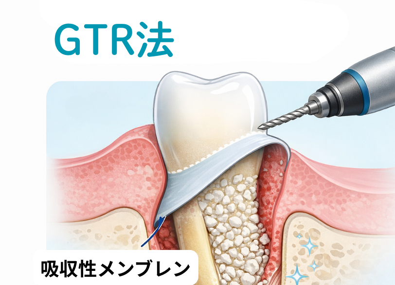 組織誘導再生法|板橋グレース歯科医院