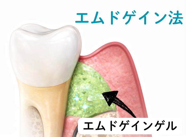 エムドゲイン法|板橋グレース歯科医院